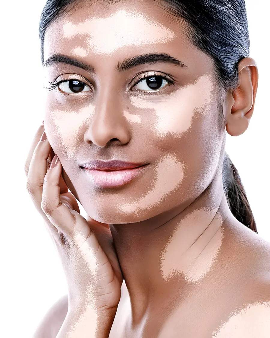Vitiligo at Cinch Clinics
